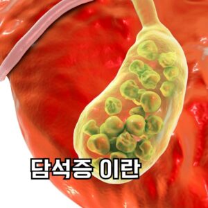 담석증 이란?