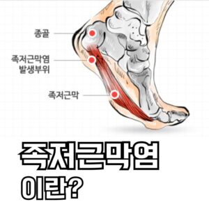 족저근막염 이란?