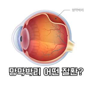 망막박리 어떤 질환?