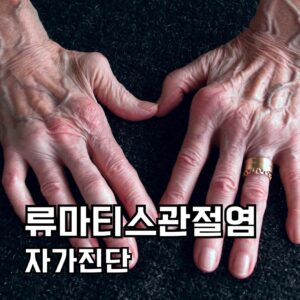 류마티스관절염 자가진단