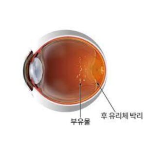 후 유리체 박리