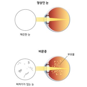 비문증 원인